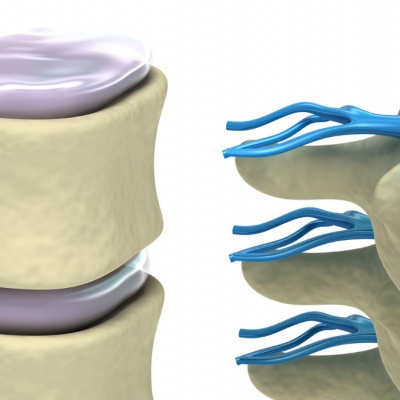 Qual o melhor tratamento para hernia de disco lombar?